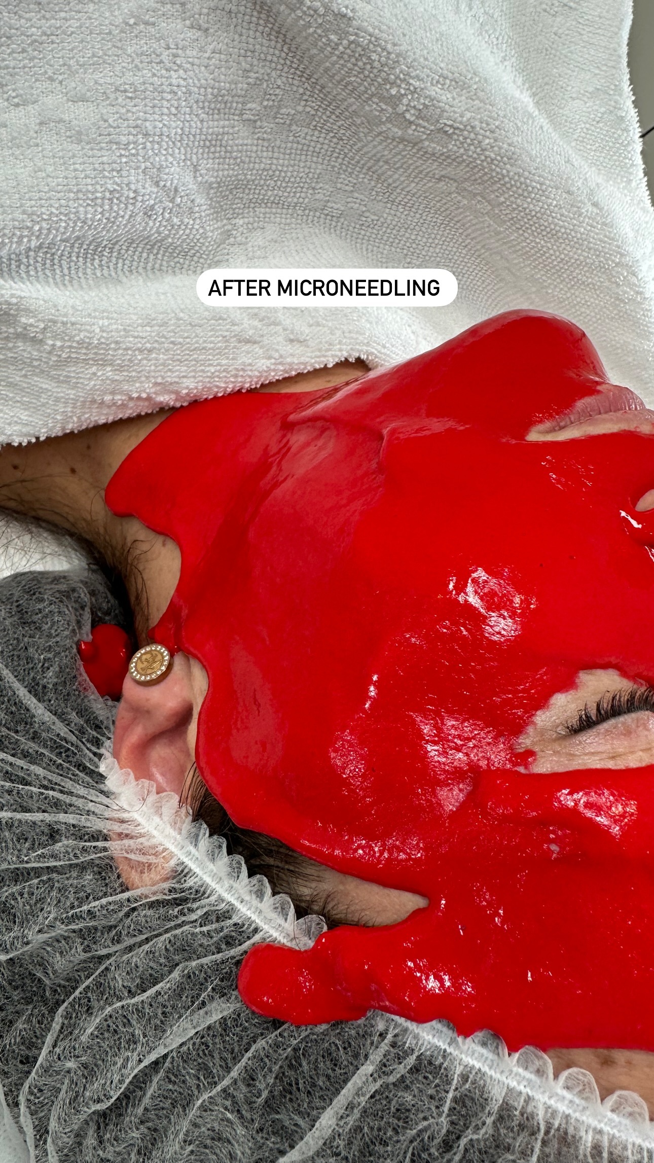 Microneedling Studio