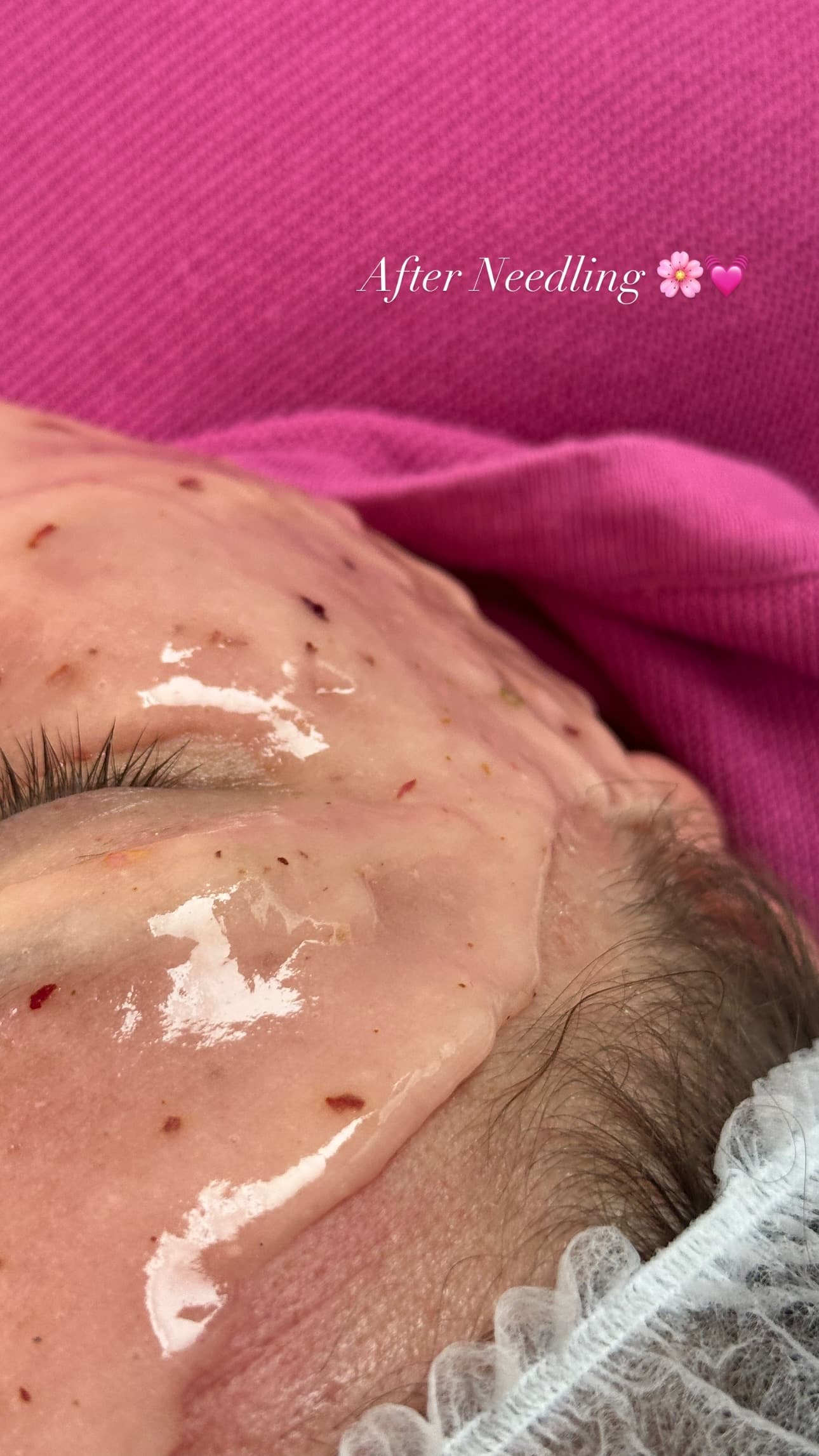 Microneedling Behandlung