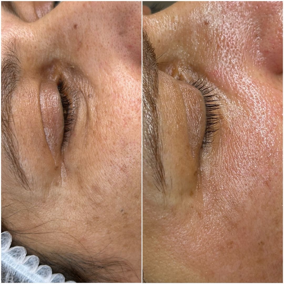 Microneedling Gesicht