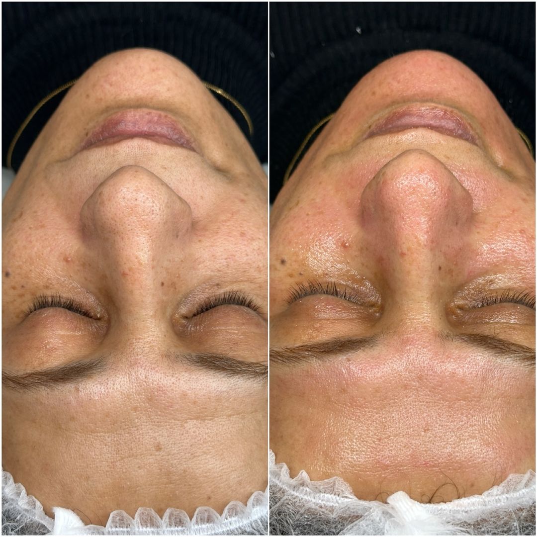 Microneedling Hautbehandlung