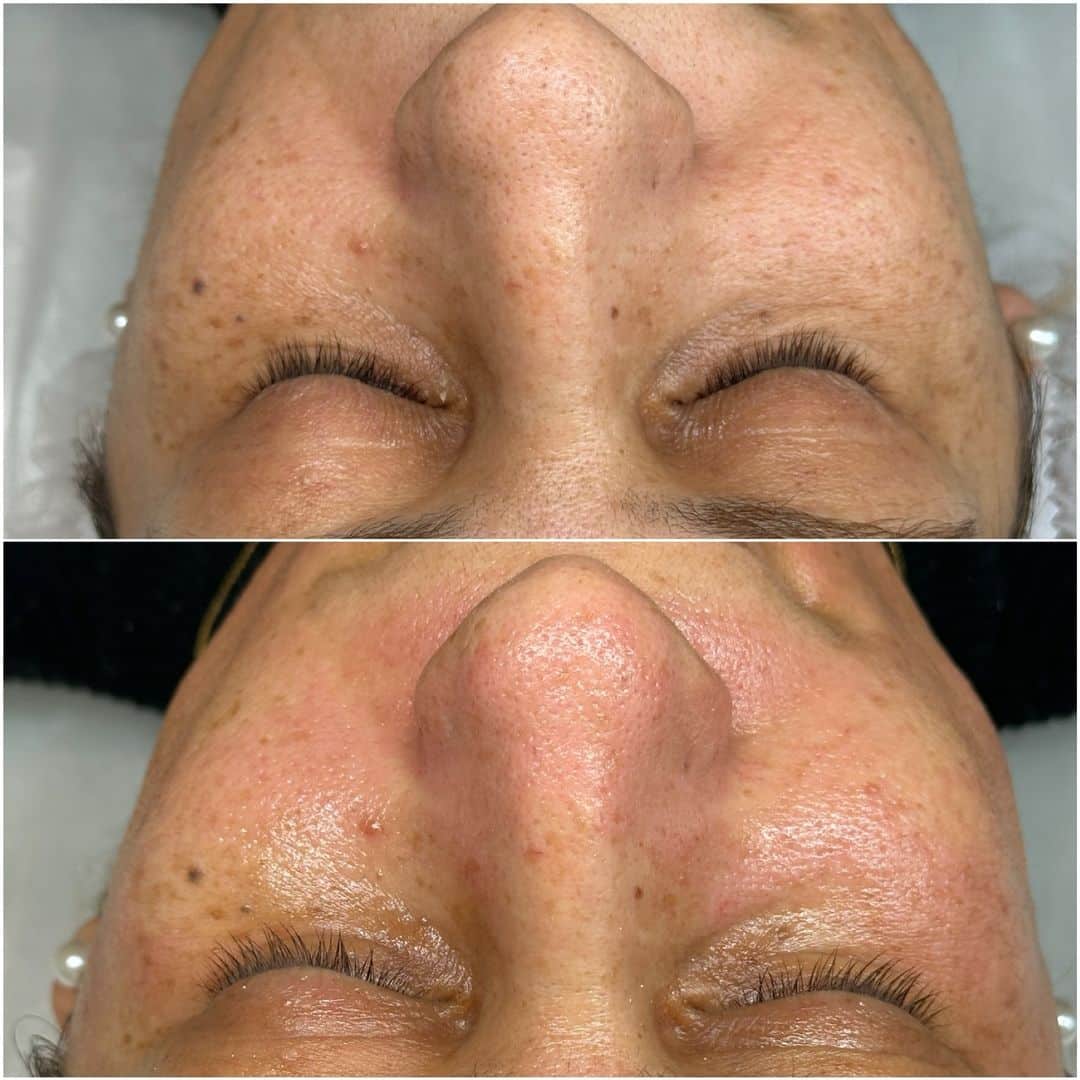 Microneedling Anwendung